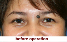 plastic-surgery-blepharoplasty